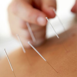 Acupuncture_needles